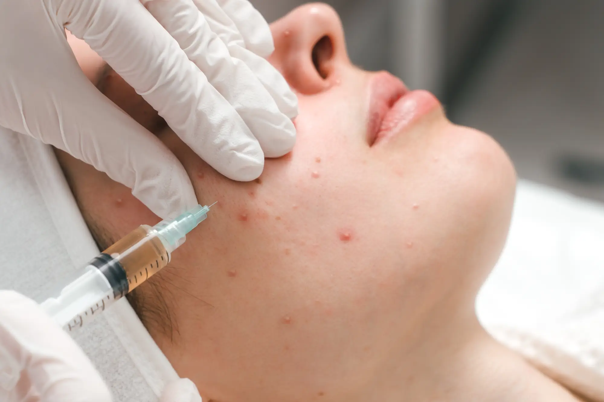 C2 Aesthetics Acne Injections in Cedar Park, TX