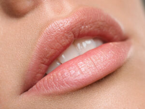 Lip Filler Special